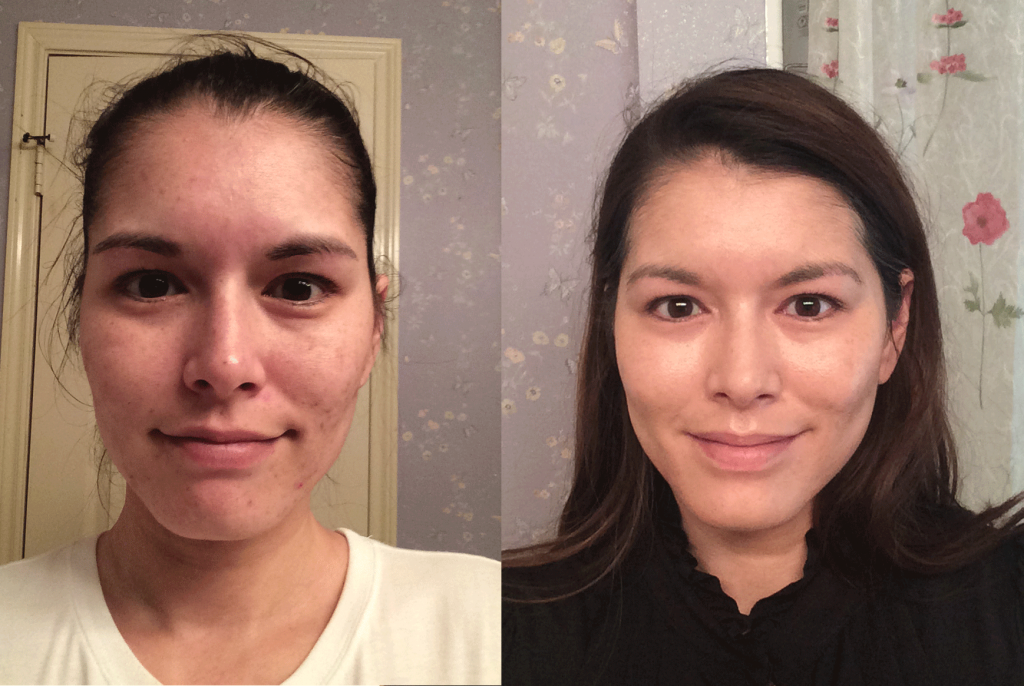 How can I get tretinoin?
